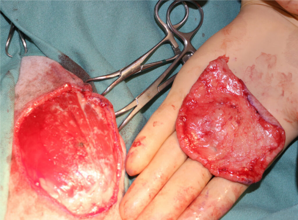 犬の皮下肥満細胞腫・写真４